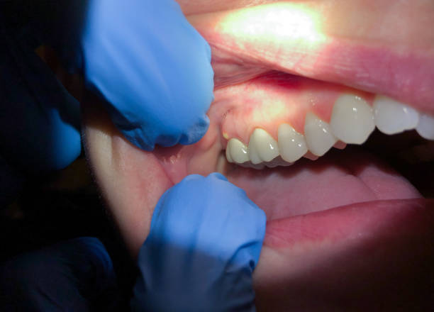 Best Emergency Root Canal Treatment in Notre Dame, IN